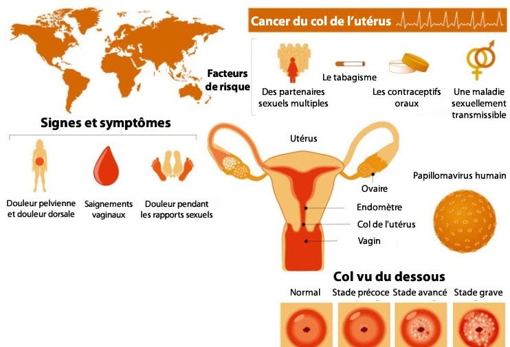 La plupart des femmes ignorent ces trois symptômes du cancer du col de