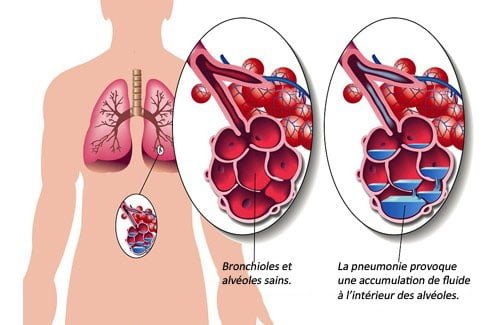 7 aliments pour traiter la pneumonie