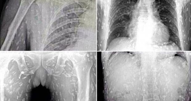 Après avoir mangé des sushis, le corps d&rsquo;un homme a été infecté par un ver!