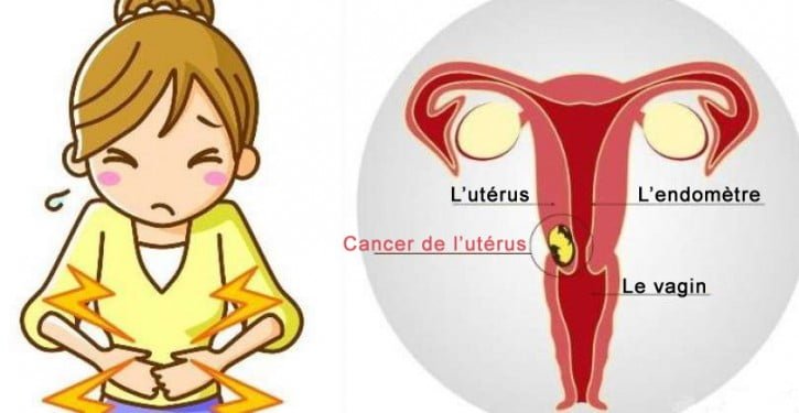 La plupart des femmes ignorent ces trois symptômes du cancer du col de l’utérus!