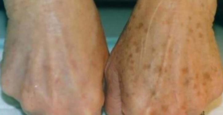 C&rsquo;est incroyable: cette femme s&rsquo;est débarrassée avec succès de cette tache noire (recette)