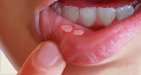 les aphtes de la bouche les aphtes de la bouche