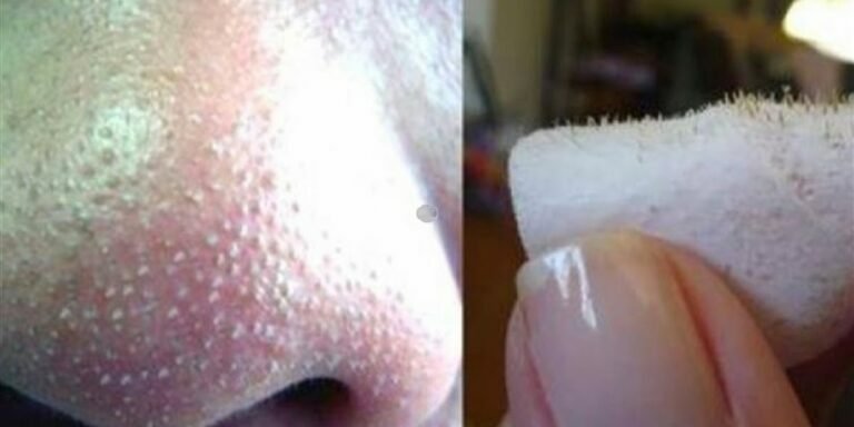 Mettez du sel, de l&rsquo;eau et du citron sur la peau. Au bout de 3 minutes, le résultat était sublimé!