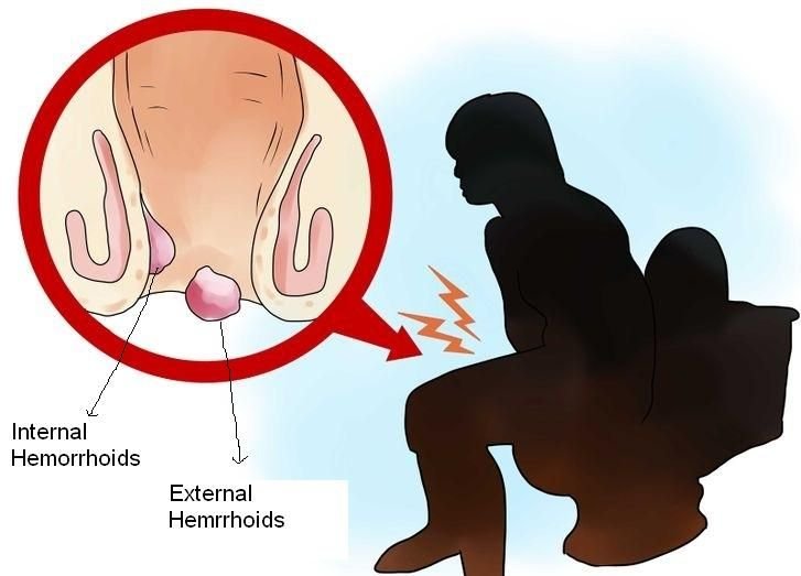 Une astuce absolue pour soigner vos hémorroïdes dans la fonction de minuterie de 24 heures! Vous n&rsquo;avez besoin que d&rsquo;ingrédients naturels …