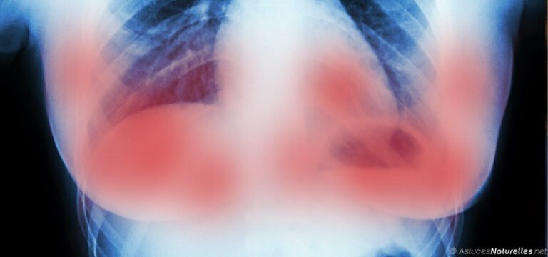 Des scientifiques d&rsquo;Amsterdam ont éliminé plusieurs tumeurs cancéreuses du sein en 11 jours sans chimiothérapie!