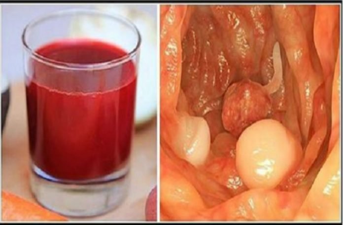 Ce jus a soigné plus de 50 000 personnes! Il peut tuer le cancer en 42 jours!