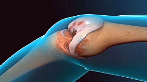 Le médecin était impressionné: cette recette peut régénérer les articulations et vous donner un nouveau genou!