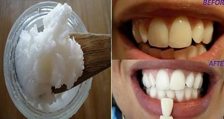 Un seul ingrédient suffit pour éliminer la mauvaise haleine, le tartre et toutes les bactéries nocives!