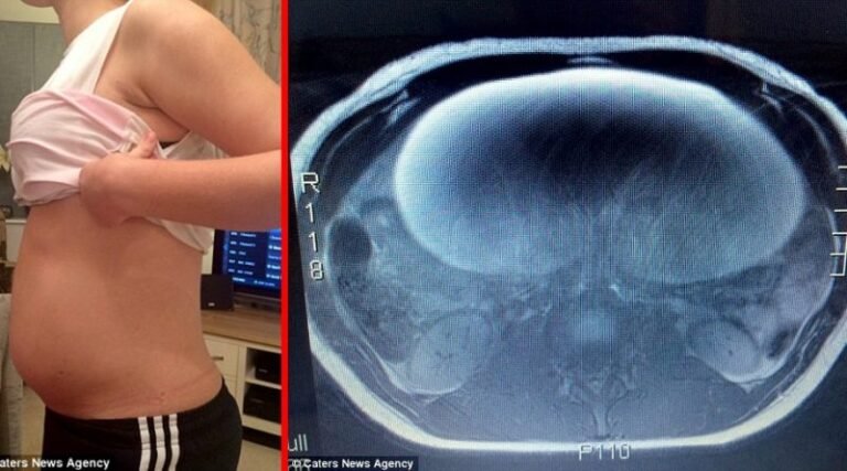 Le médecin pensait que le garçon était enceinte, mais sa vraie surprise l&rsquo;attendait dans l&rsquo;utérus! Pire!