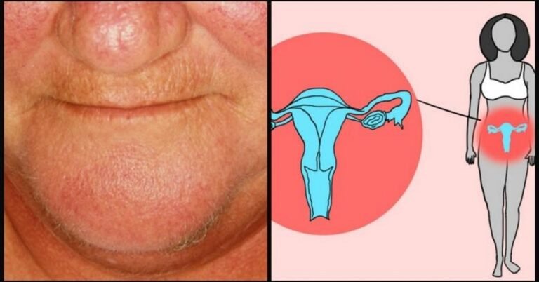 Je ne sais pas si les poils du menton en sont le symptôme! Tout le monde devrait savoir …