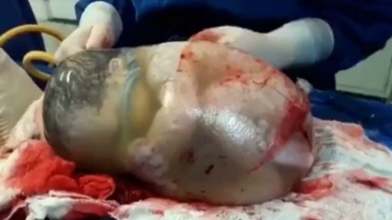vidéo. L&rsquo;incroyable naissance d&rsquo;un bébé toujours dans le sac amniotique!