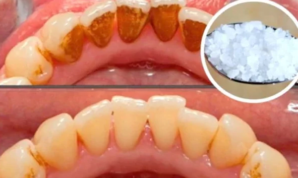 Voici comment blanchir les dents jaunes