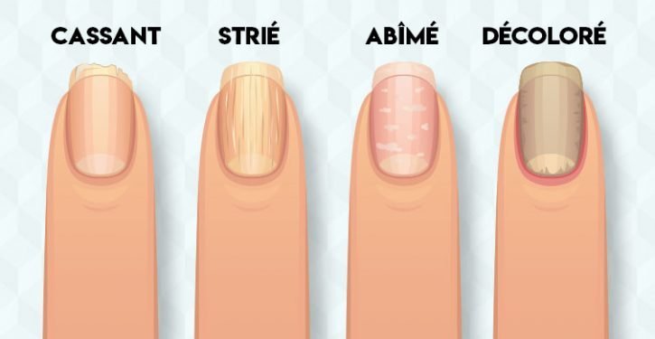 8 problèmes de santé révélés par vos ongles