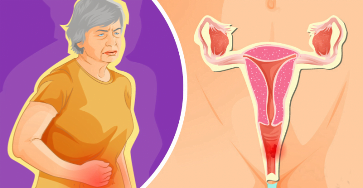 Cancer vaginal: types, symptômes, facteurs de risque et prévention