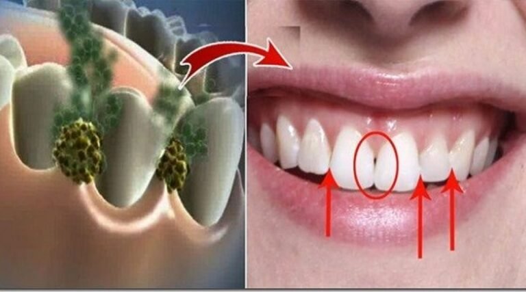 Utilisez ce bain de bouche au citron pour éliminer la mauvaise haleine