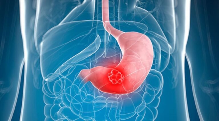 Cet aliment augmente le risque de cancer de l&rsquo;estomac