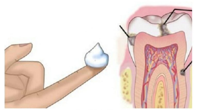 Ceci est une astuce simple pour éviter la carie dentaire