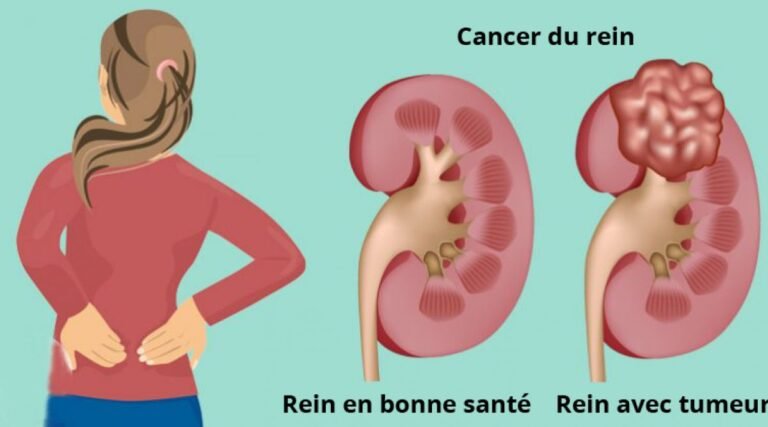 Faites attention aux 7 symptômes du cancer du rein