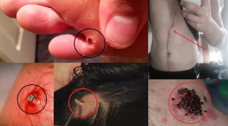 Quels sont les symptômes de parasite dans notre corps ?