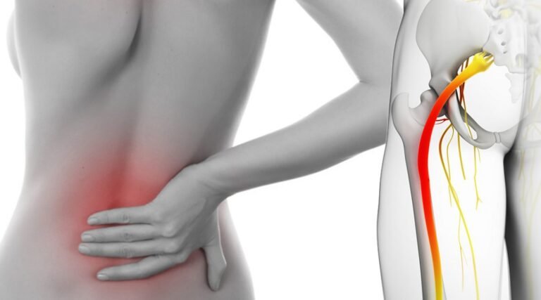 7 façons de combattre la sciatique