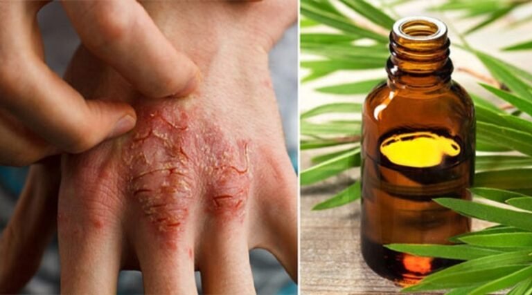 L&rsquo;huile d&rsquo;arbre à thé aide à résoudre de nombreux problèmes de santé
