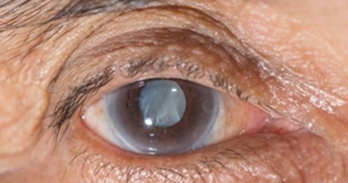 Adieu Les Cataractes! Vous Pouvez Maintenant Vous Débarrasser Des Cataractes Sans Recourir À La Chirurgie