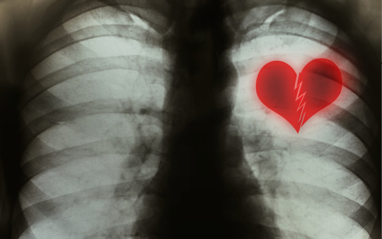 Vous Pouvez Vraiment Mourir D&rsquo;un Cœur Brisé – Explique Un Cardiologue