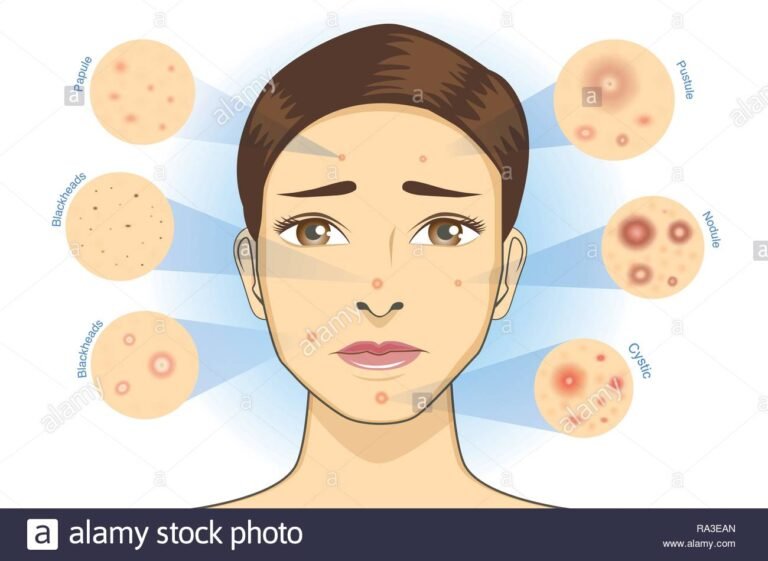 Quelles sont les causes de l&rsquo;acné ?