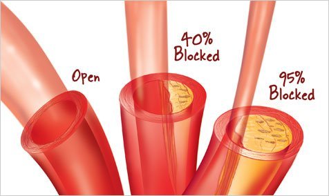 Tout ce que vous devez savoir sur le cholestérol élevé