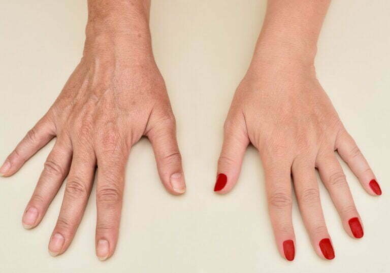 Traitement des mains vieillissantes